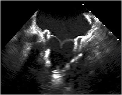 Transcatheter Mitral Valve Replacement and Thrombosis: A Review